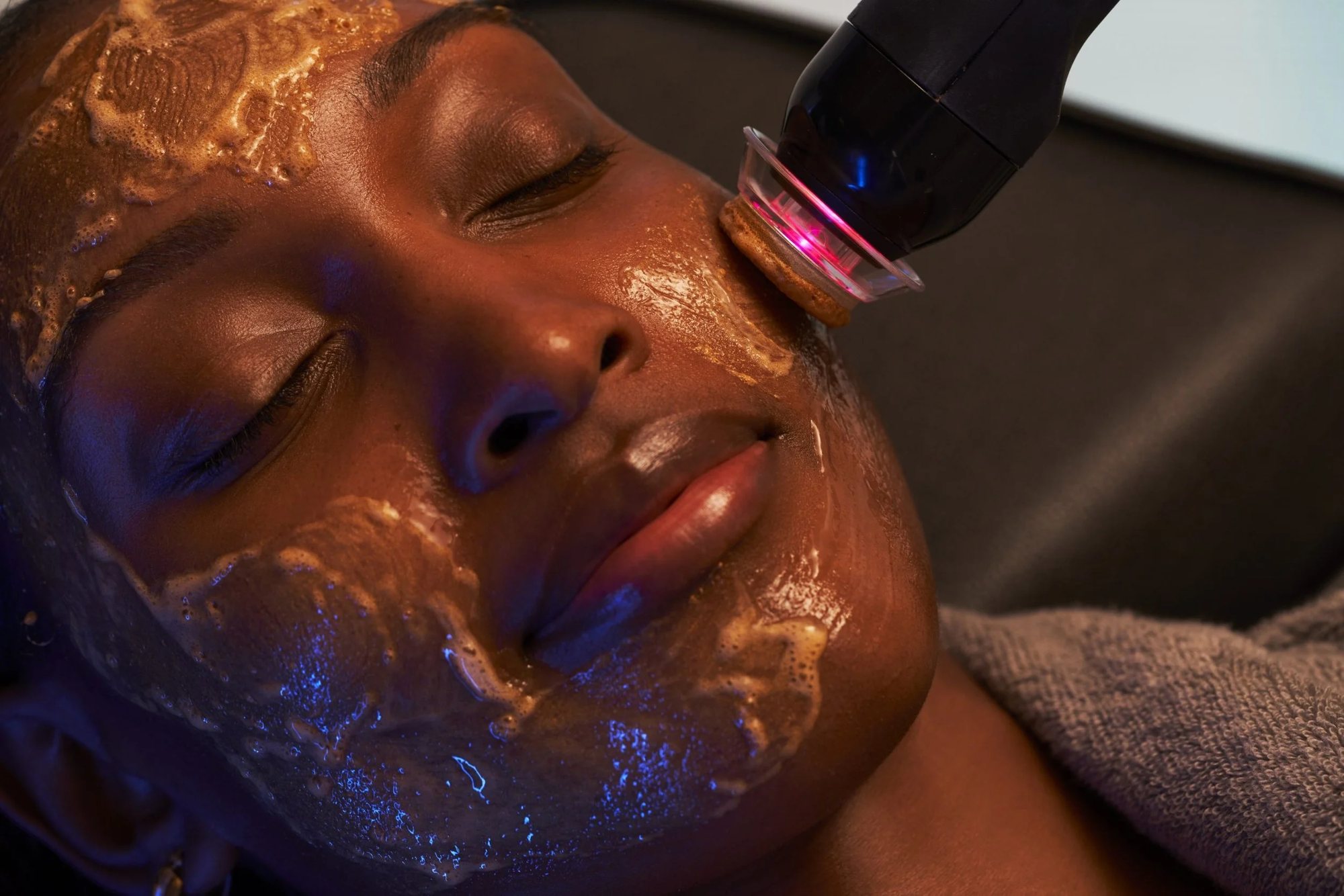 Jet Plasma Skin Tightening